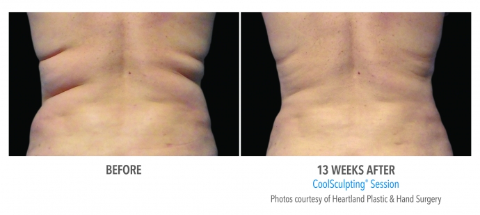 coolsculpting-flank-back-nyc-female-3