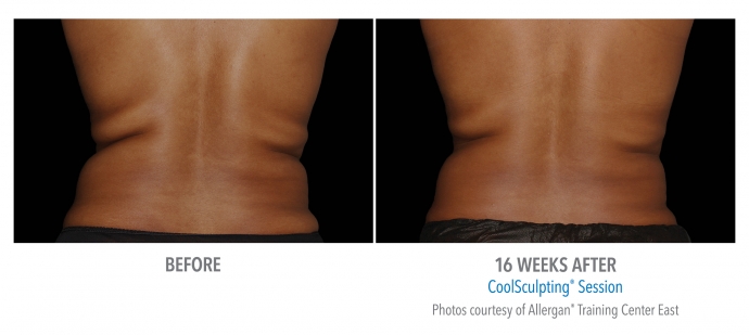 coolsculpting-flank-back-nyc-female-4