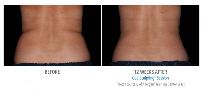 coolsculpting-flank-back-nyc-female-7
