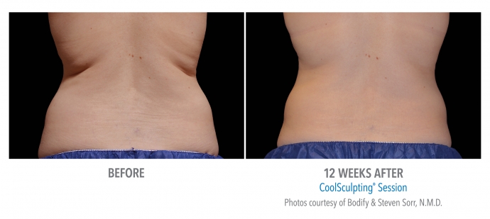 coolsculpting-flank-back-nyc-female-8