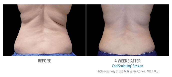 coolsculpting-flank-back-nyc-female-9