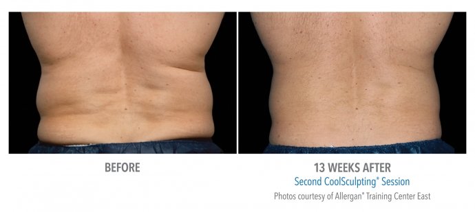 coolsculpting-flank-back-nyc-male-4