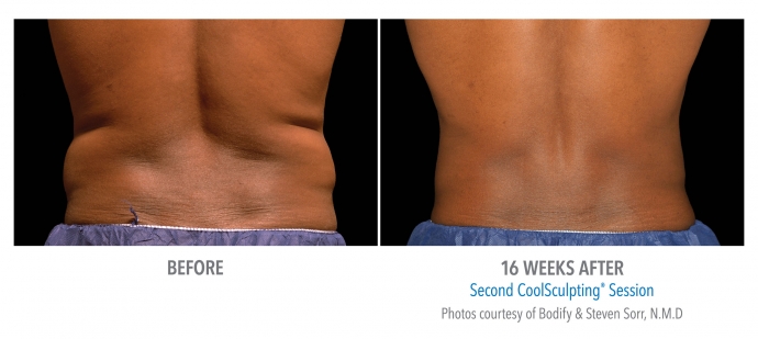 coolsculpting-flank-back-nyc-male-5
