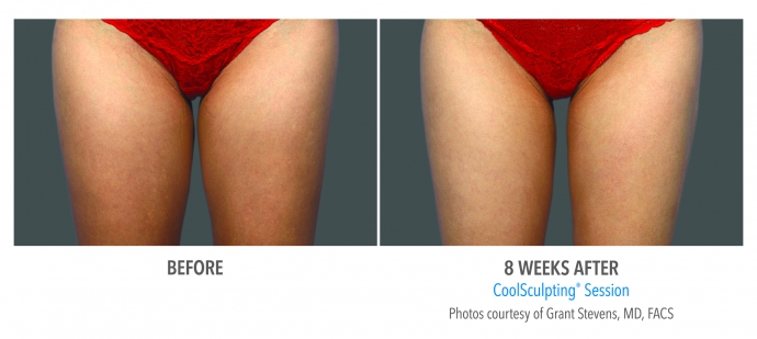 coolsculpting-inner-thigh-nyc-female-1