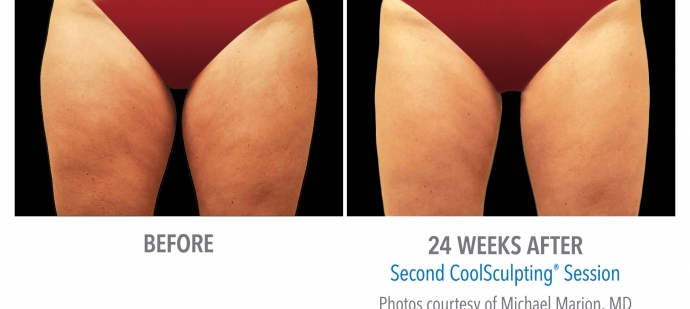 coolsculpting-inner-thigh-nyc-female-2