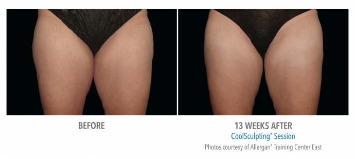 coolsculpting-inner-thigh-nyc-female-4
