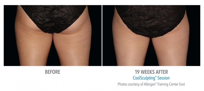 coolsculpting-inner-thigh-nyc-female-5