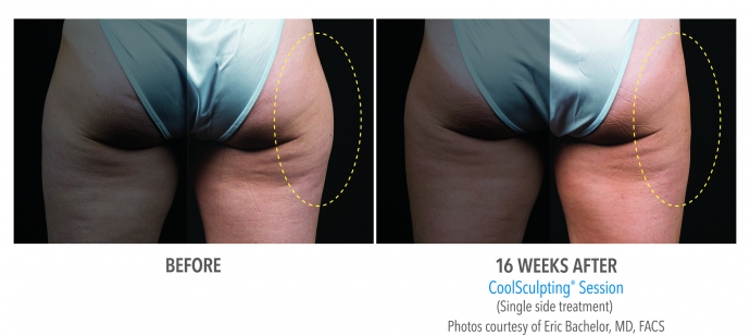 coolsculpting-outer-thigh-nyc-female-1